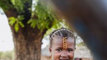 Sénégal : Une fillette de 4 ans capable de sourire pour la première fois après une intervention chirurgicale